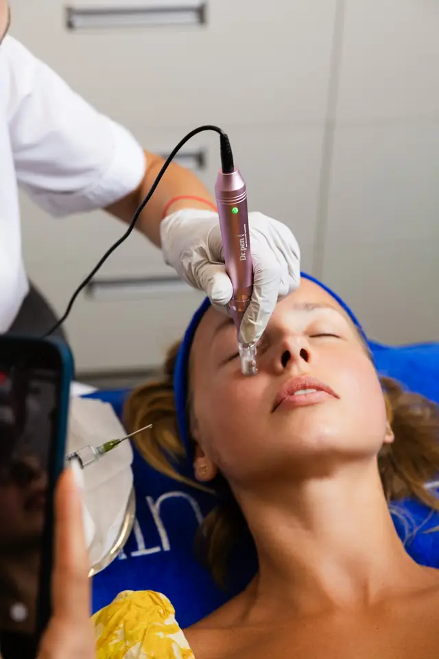 Microneedling along the cheek